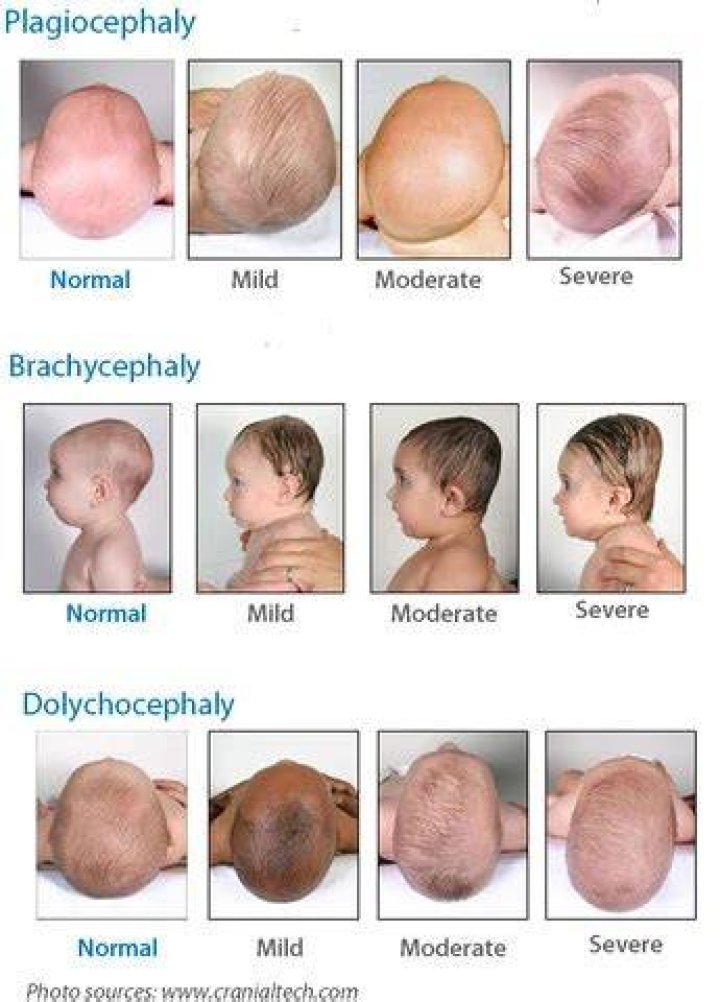 Can moderate plagiocephaly correct itself?