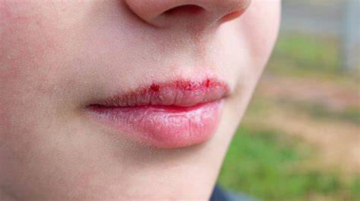 How To Get Your Lips To Stop Burning After Getting Buffalo Sauce On Them? (Question)