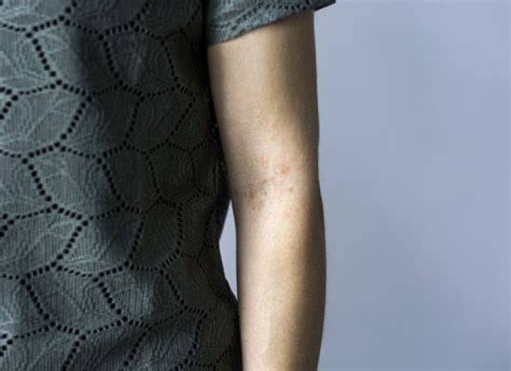 Is polymorphic light eruption an autoimmune disease?