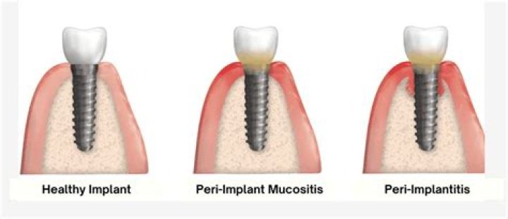 What Causes Peri-implantitits? (Solution found)