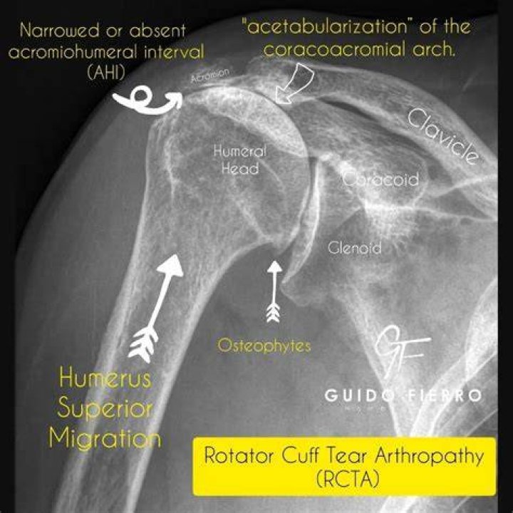 What does rotator cuff arthropathy mean?