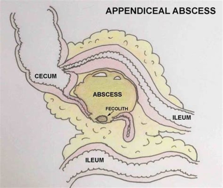 What Is A Peri-appendicular Abscess?